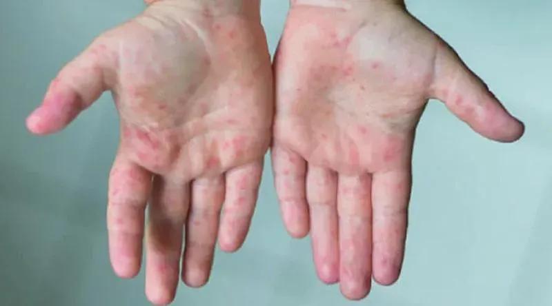 দেশে হামে আরও ৭ শিশুর প্রাণহানি