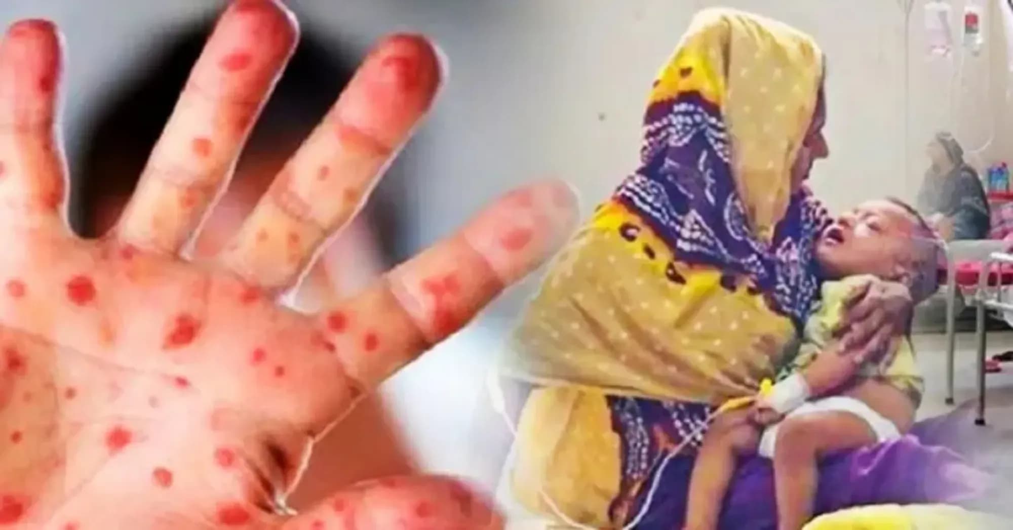 হাম উপসর্গে আরও ১১ জনের মৃত্যু