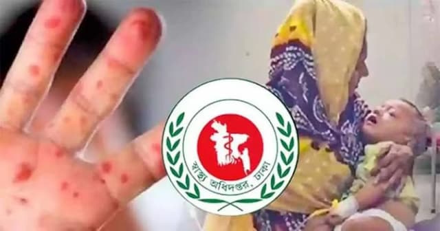 একদিনে হাম উপসর্গে ৭ জনের মৃত্যু